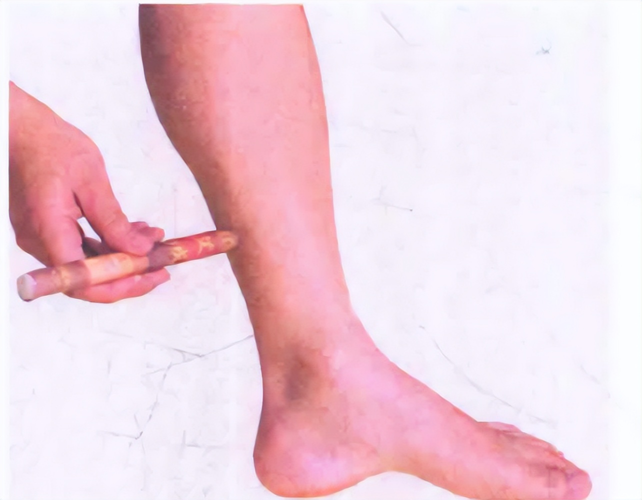 蠡沟穴——调理妇科炎症经验穴