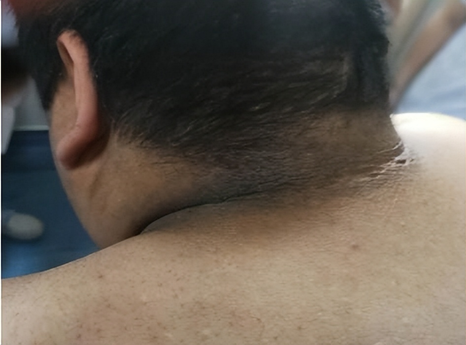 黑棘皮病，揭开你神秘的面纱