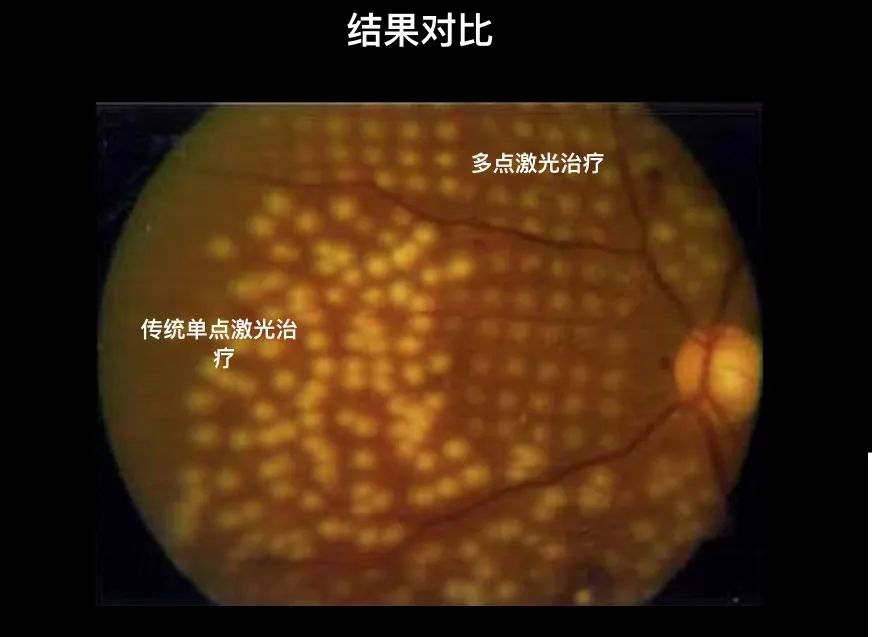 眼底激光治疗仪,577眼底激光