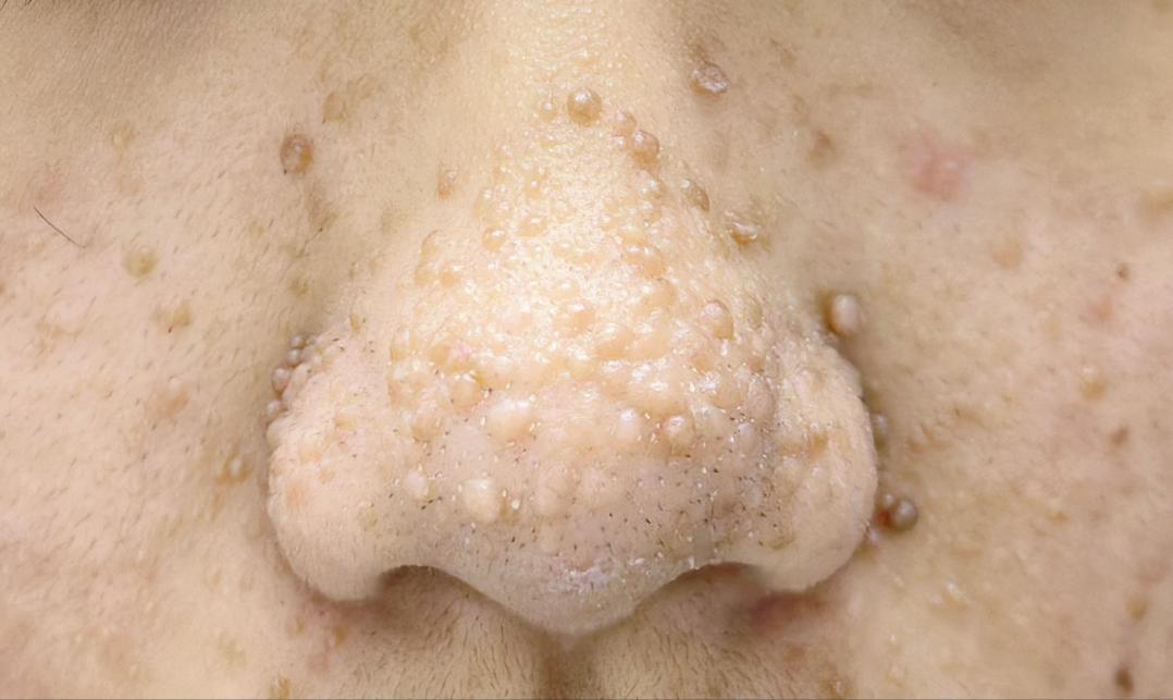 19岁女孩患罕见皮肤病,女子患怪病脸上长着纤维巨瘤