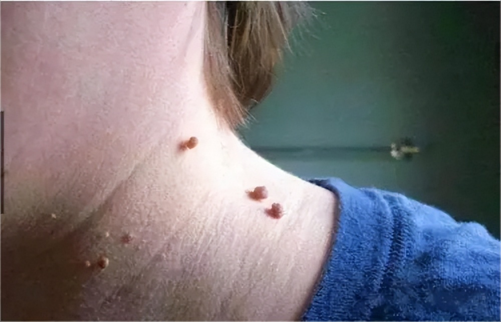 脖子上长了很多丝状疣怎么去除,脖子上长的小疙瘩丝状疣怎么治