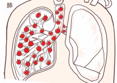 玻尿酸的填充有哪些危害,玻尿酸填充脸部凹陷危害