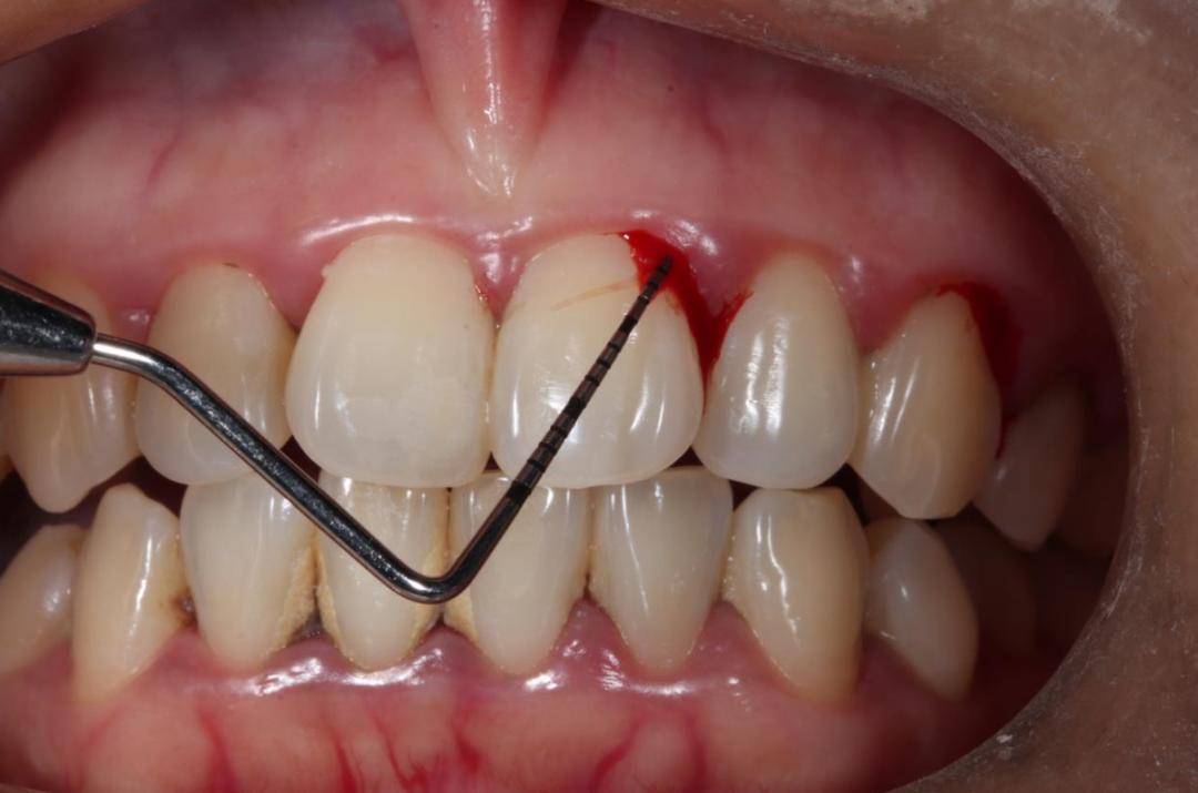 老是牙龈出血该吃什么药,牙龈老是出血不管行不行