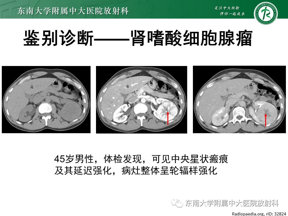 好文分享——《肾血管平滑肌脂肪瘤》