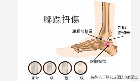巴西队内马尔脚踝,内马尔脚踝90度扭曲