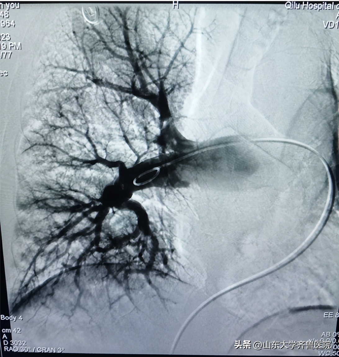 齐鲁医院首例,山东齐鲁医院血栓取栓术