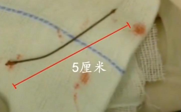 17岁男孩头痛被送进医院，医生一看X光片直接傻眼：没救了