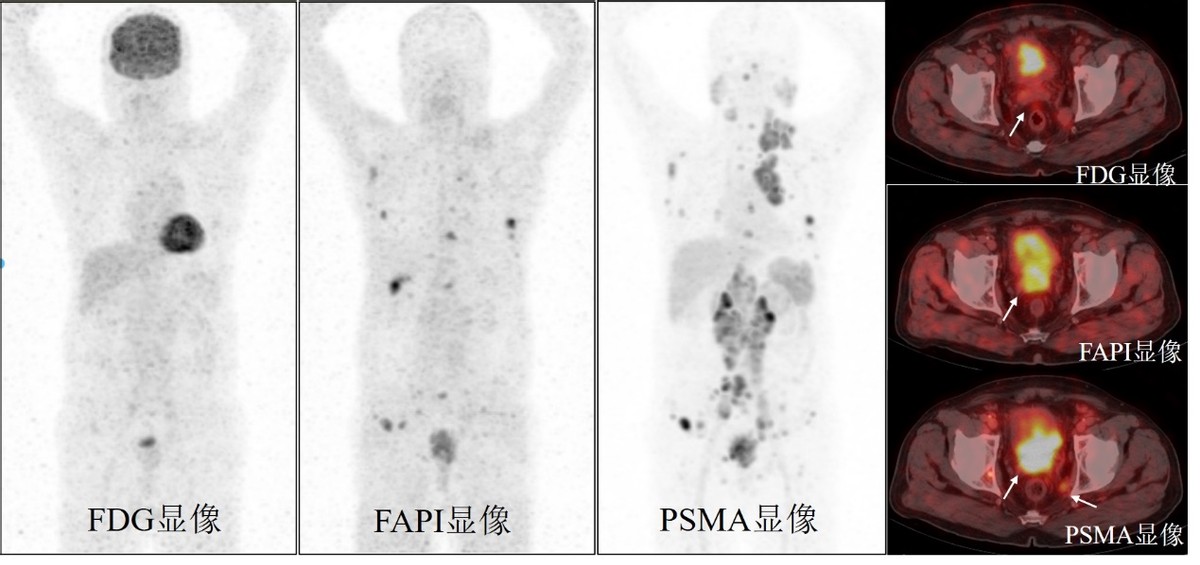 哈医大一院核医学科PET/CT分子影像中心精确诊疗让前列腺癌“无处遁形”