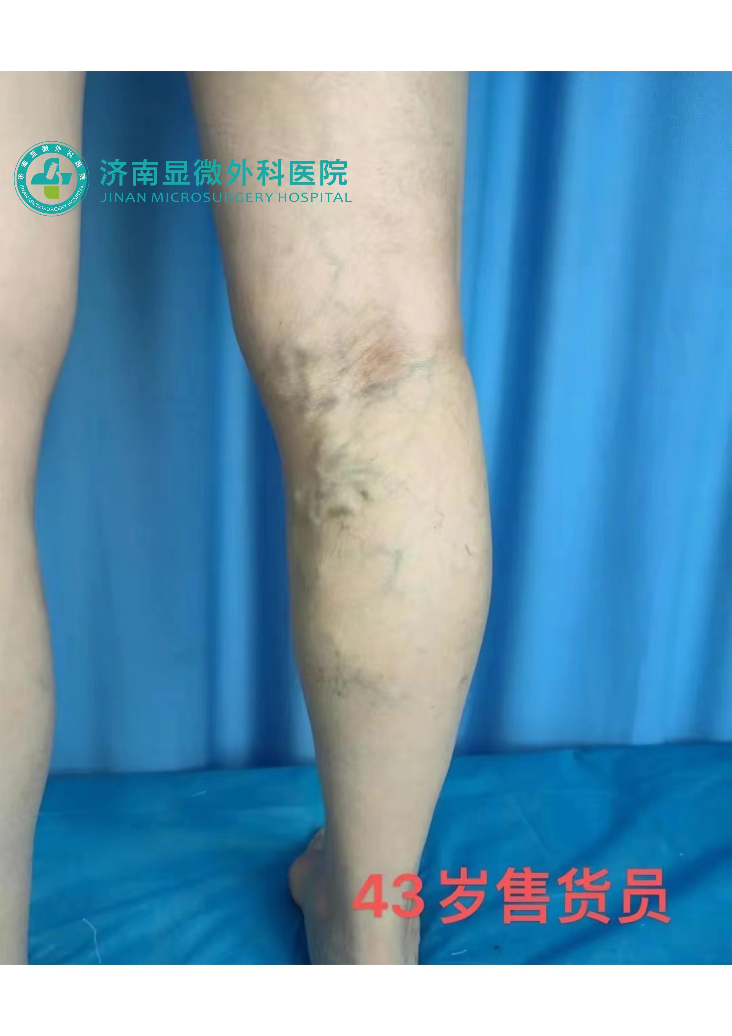 静脉曲张去哪里治疗效果最好,静脉轻度曲张怎么治疗最好