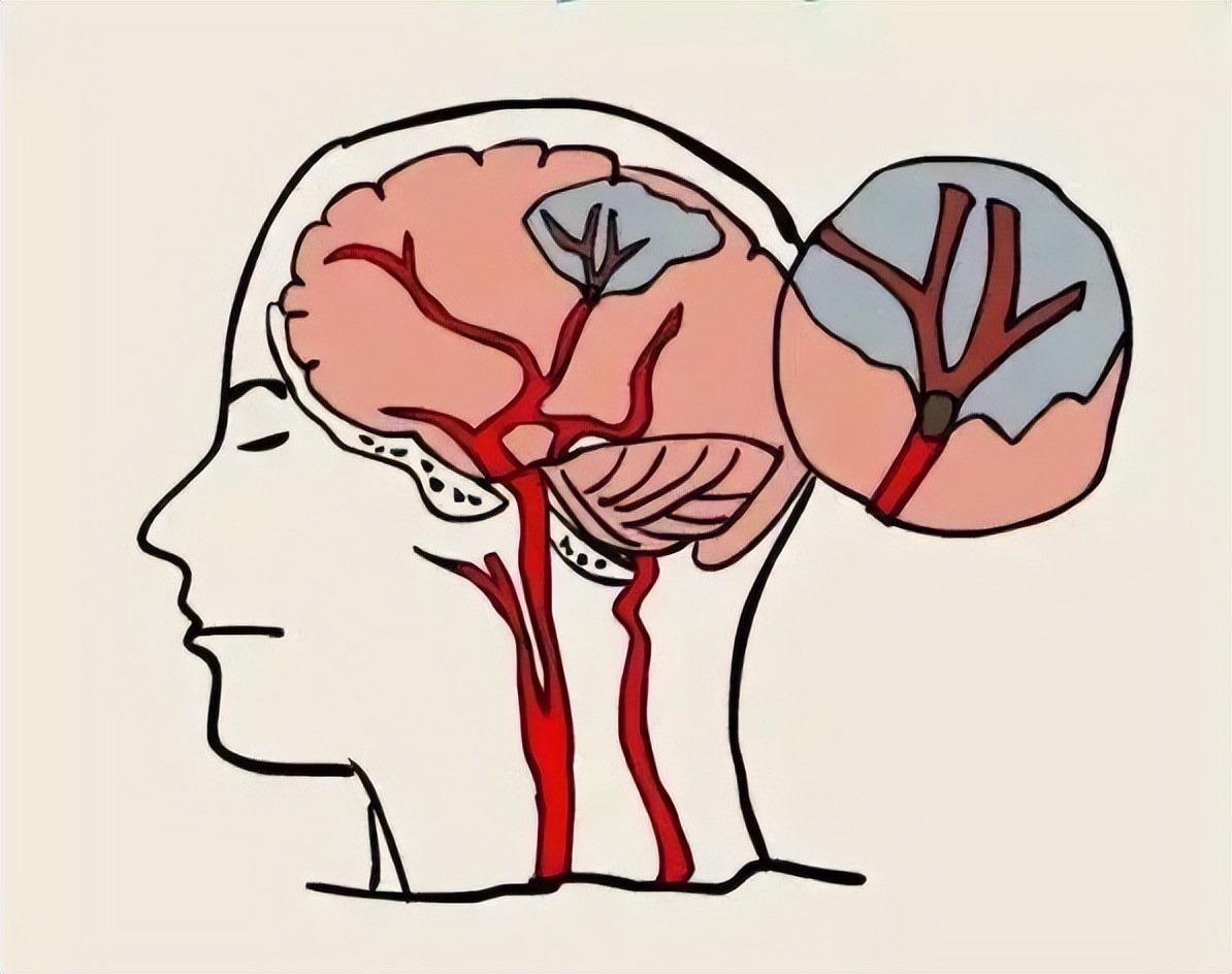 中风与脑梗有区别吗,中风和脑梗的区别在哪里