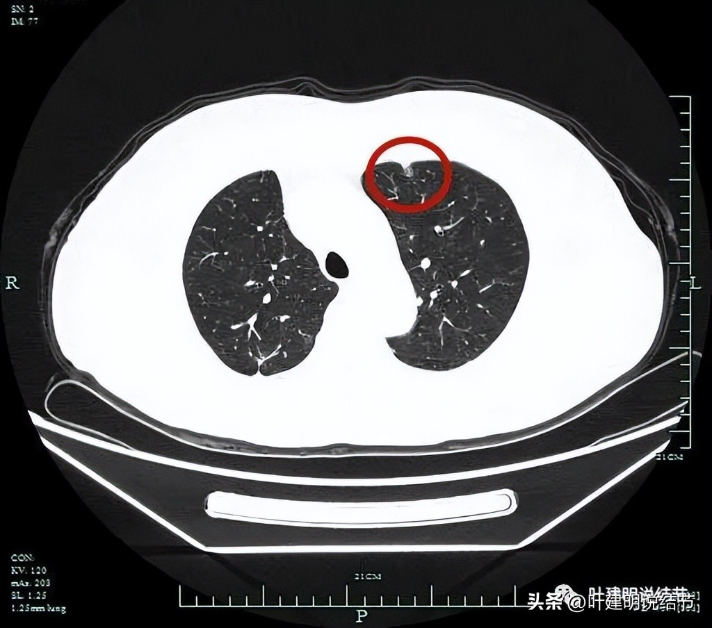 右下叶磨玻璃6mm结节基本上是癌,右下叶少许炎症上叶磨玻璃结节