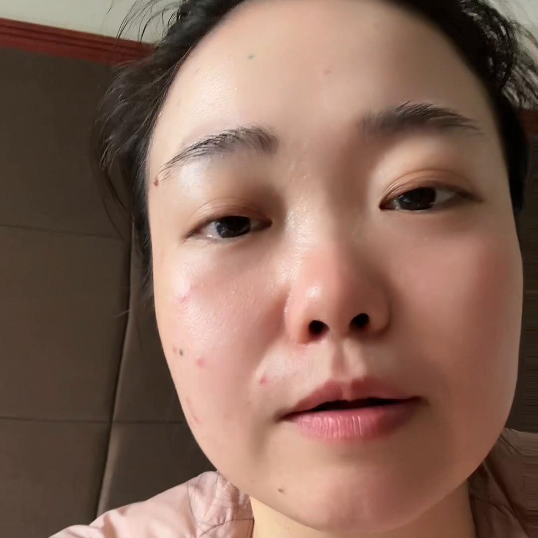 腰果过敏吃什么中药,过敏了敢不敢吃腰果