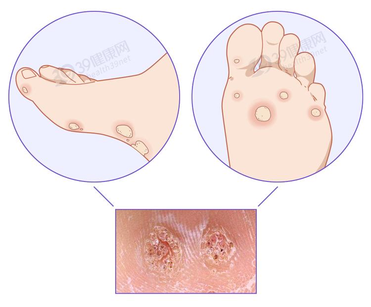 左腋下长小肉粒是hpv感染吗,腋下长了一个丝状疣一定是hpv吗