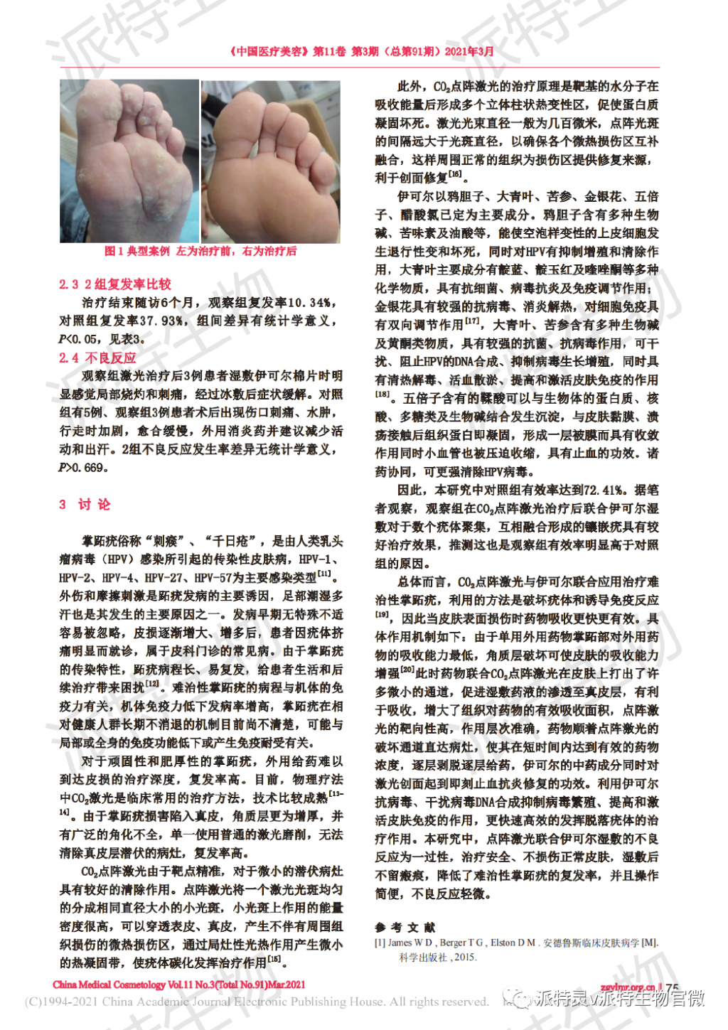 co2点阵激光治疗妇科疾病,脉冲激光治疗跖疣