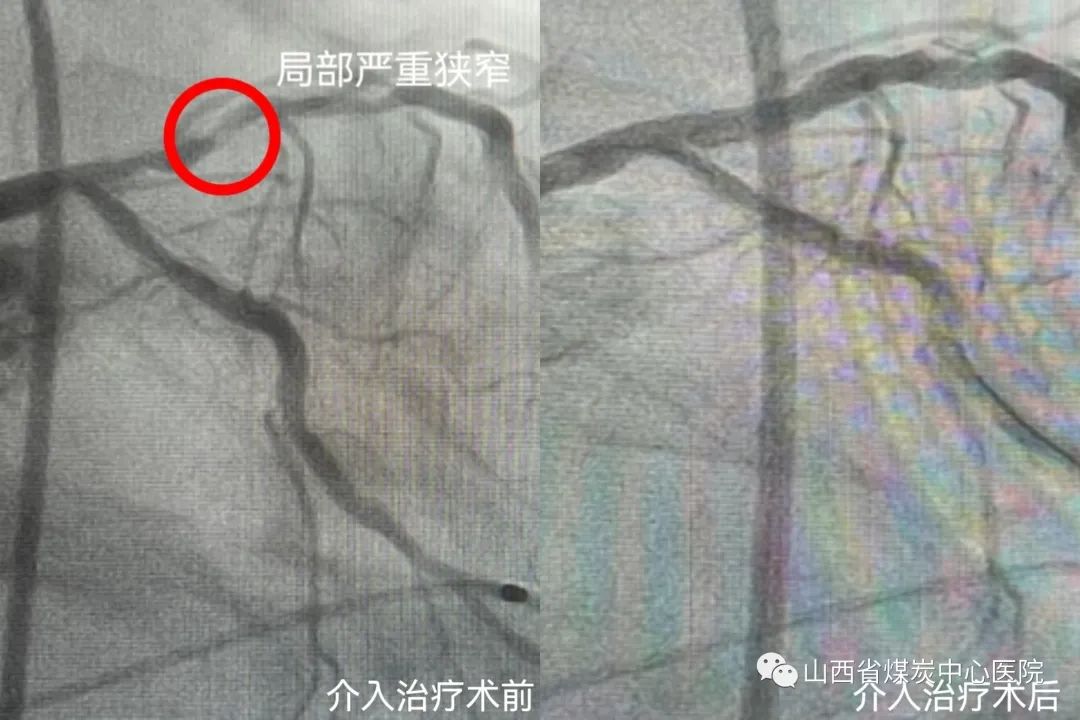 山西煤炭医院心脏中心怎么样,山西省心血管病医院心脏移植成功