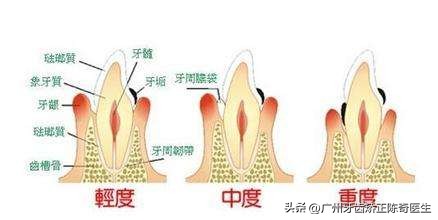 突发牙齿疼痛怎么缓解,毫无征兆的牙齿痛是怎么回事