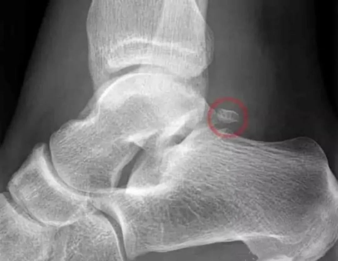 脚背及脚踝疼痛见于哪些疾病,脚踝外侧面疼痛警惕大病