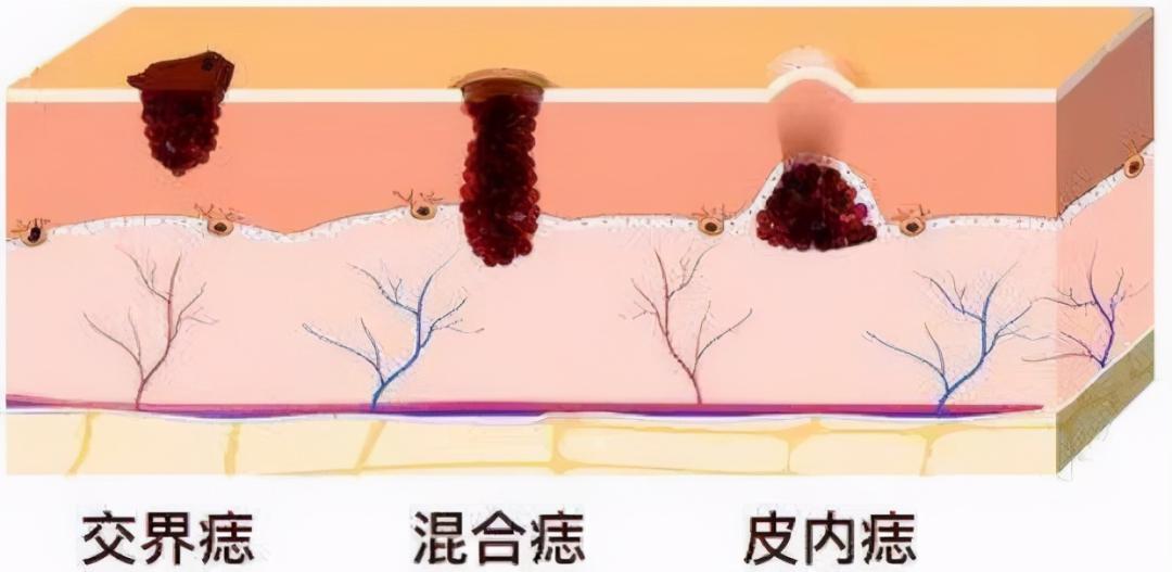 一旦发现自己身上有这4个征兆,肝癌有痣的前兆