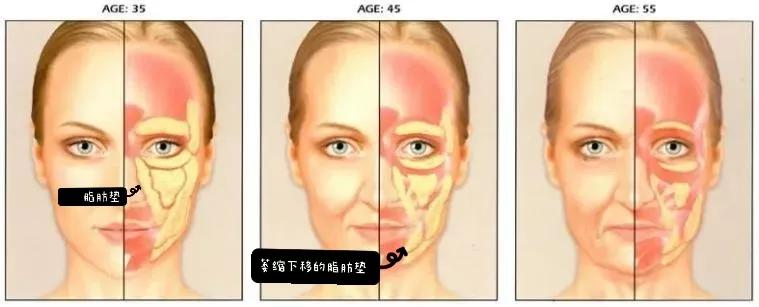 刚做的线雕,刚做线雕后脸上有凹陷正常吗