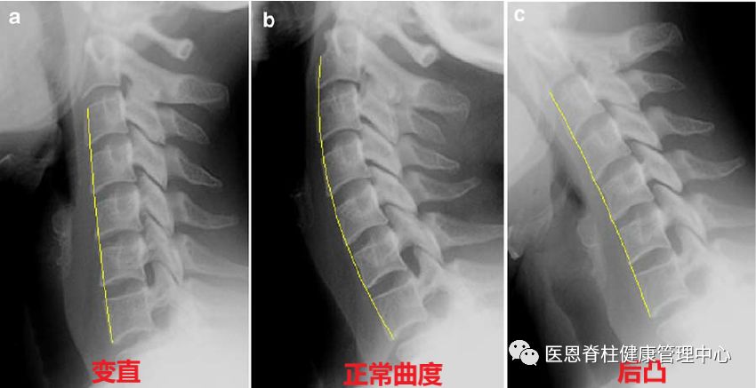 腰椎生理前凸消失是什么意思,颈椎间盘向后局限性突出