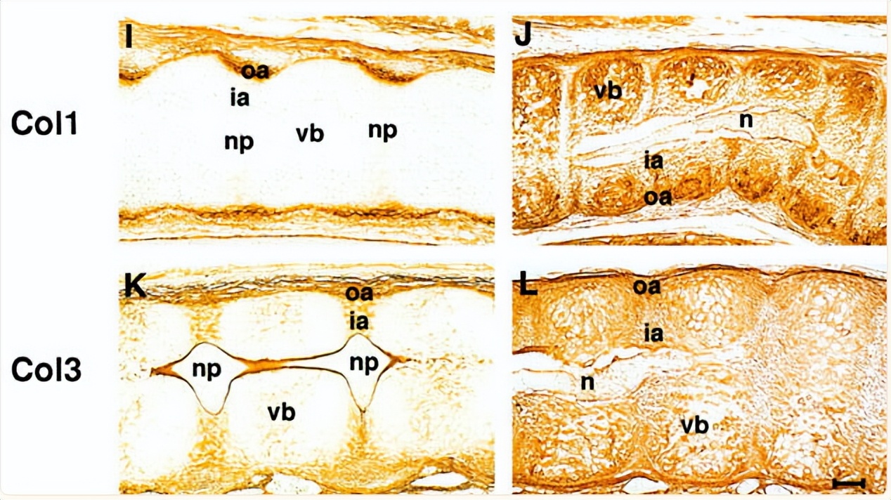 探讨胶原蛋白II在软骨中表达，对于去除节弦中异位变化