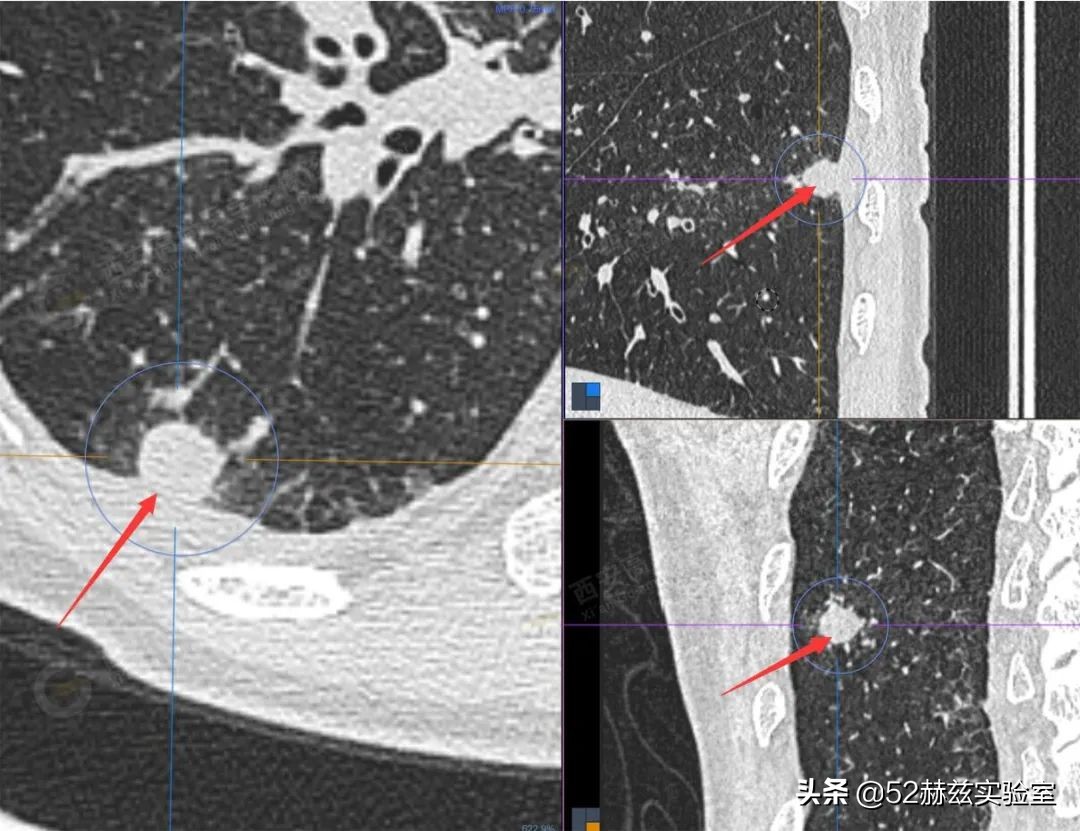 从13000元骤降至700元！看国产心脏支架如何吊打国外？
