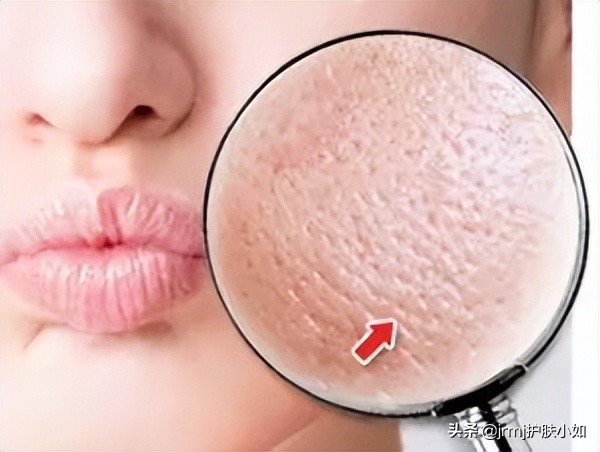 不靠任何手段改善痘痘,去黑头收缩毛孔最有效的医美