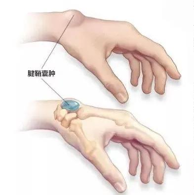 手背上长了个小凸起的包不痛不痒,手背突然起了个包