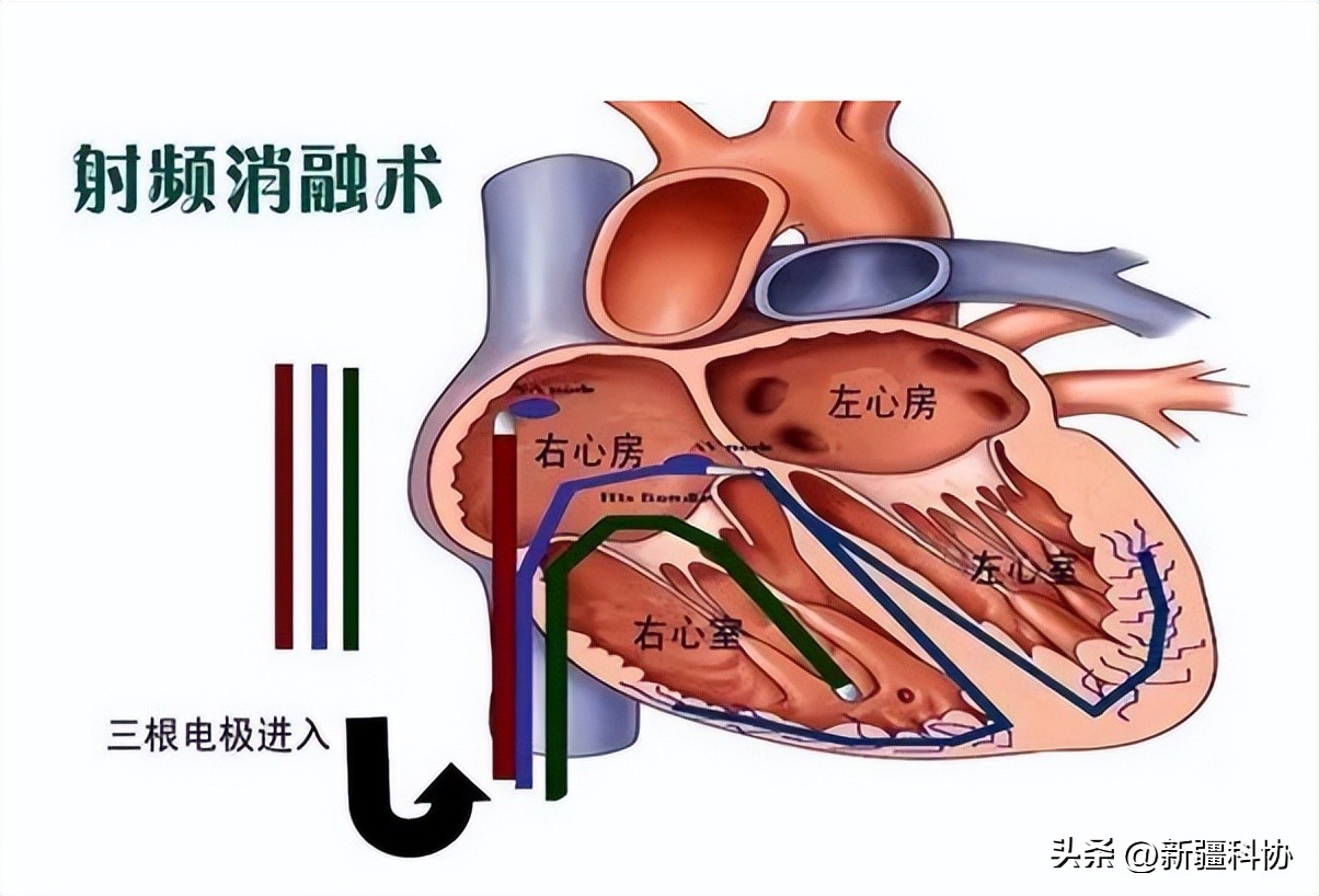 心律失常一定要采用射频消融吗,心律失常射频消融术哪里做得好