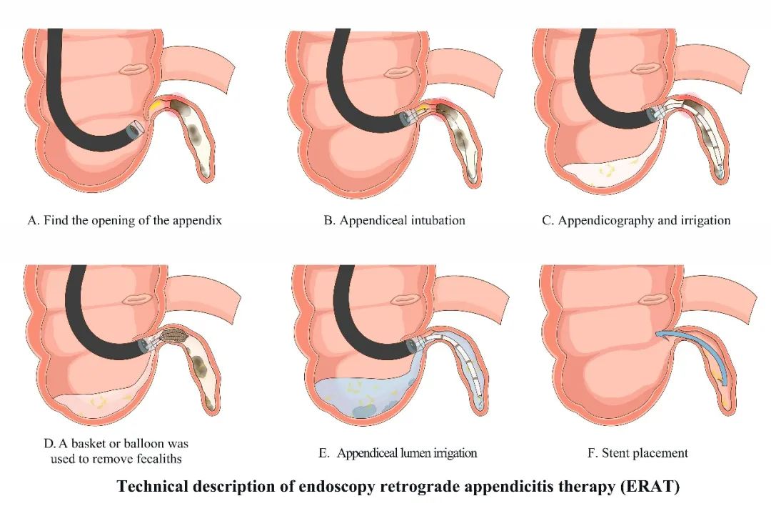 郑州大学第一附属医院消化病院刘冰熔教授团队内镜逆行阑尾炎治疗（ERAT）研究成果荣登国际著名期刊封面