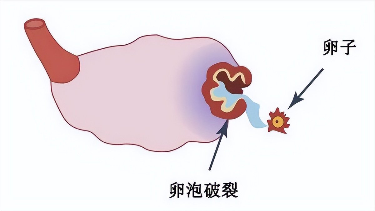 大姨妈完了又有子宫出血怎么治疗,异常子宫出血没干净为啥月经又来