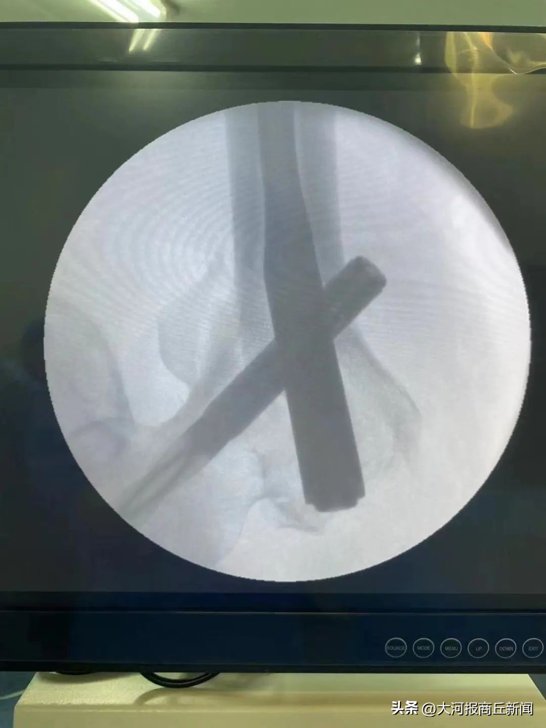 骨科医生腓骨骨折复位固定成功,骨科切开复位内固定