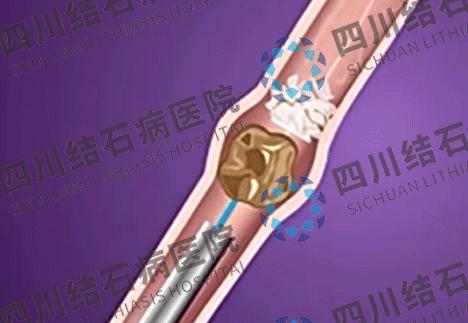 四川省治疗肾结石最好的医院,肾结石医疗方法