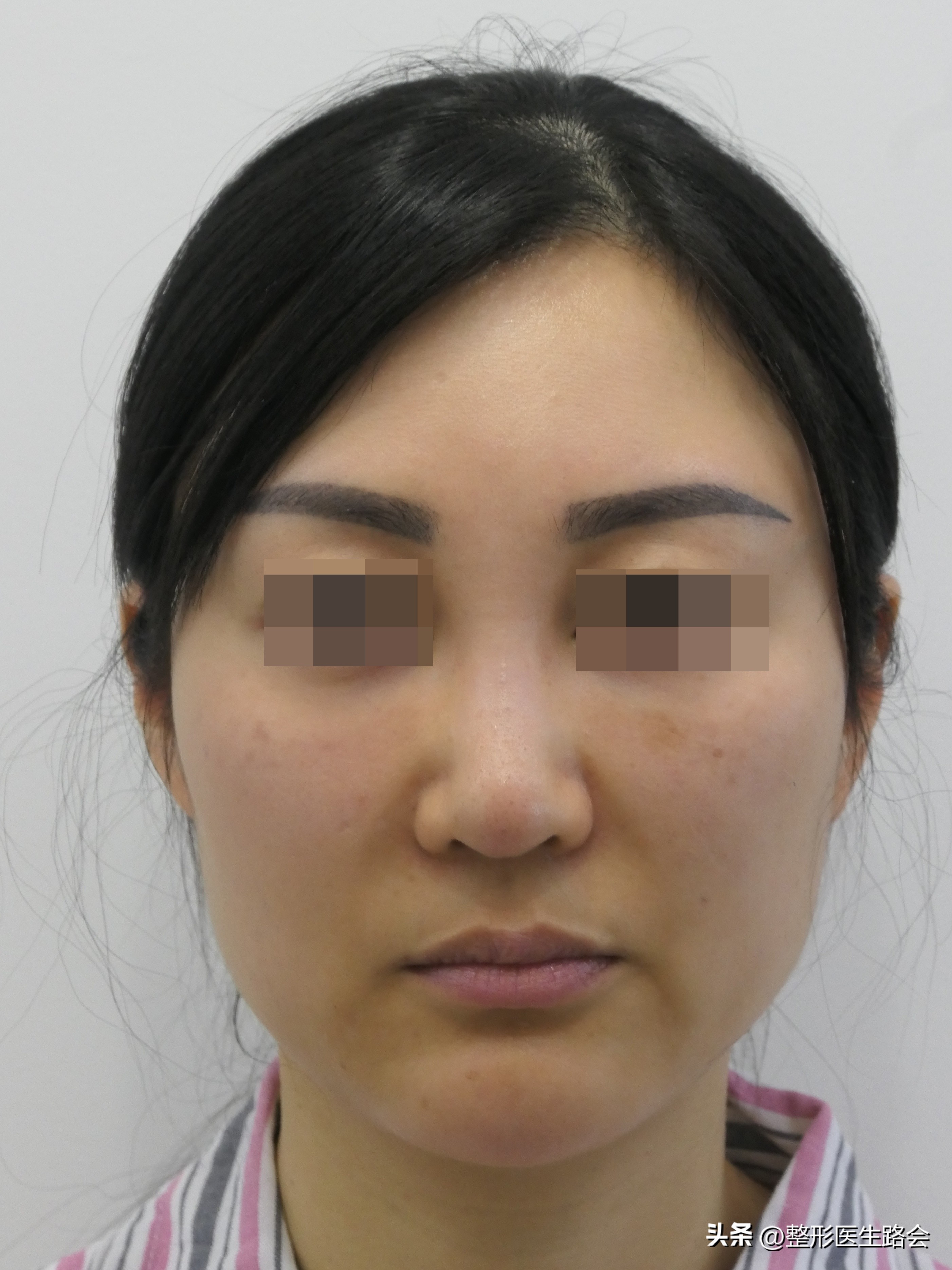 做鼻基底填充消除法令纹有风险吗,鼻基底填充能消除法令纹吗