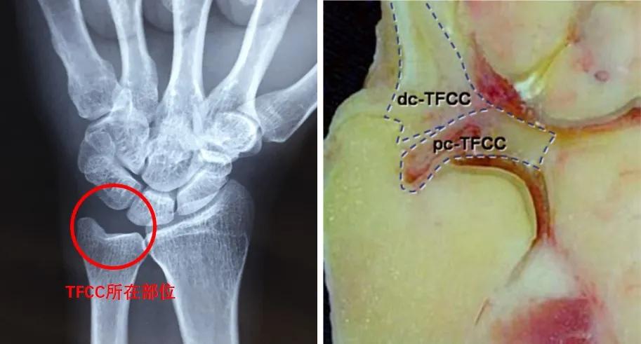手腕三角纤维软骨复合体损伤,手腕三角软骨复合体损伤症状