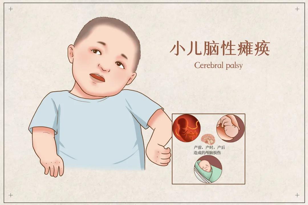 脑瘫肢体畸形怎么描述,针刀治疗脑瘫肢体畸形