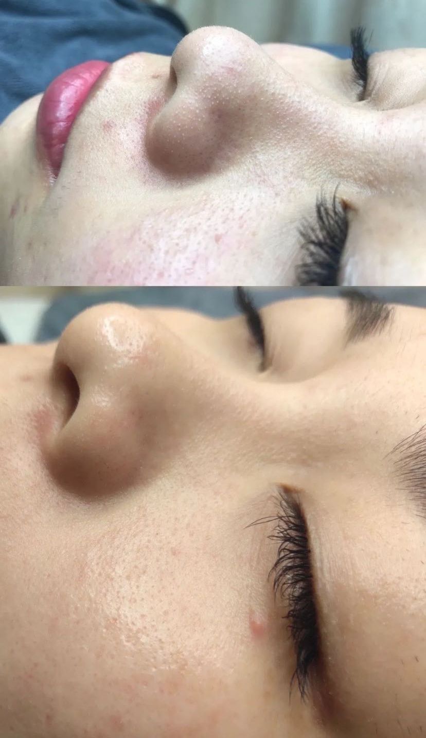 毛孔堵塞怎样才能疏通毛孔,身上毛孔堵塞不出汗怎么疏通毛孔