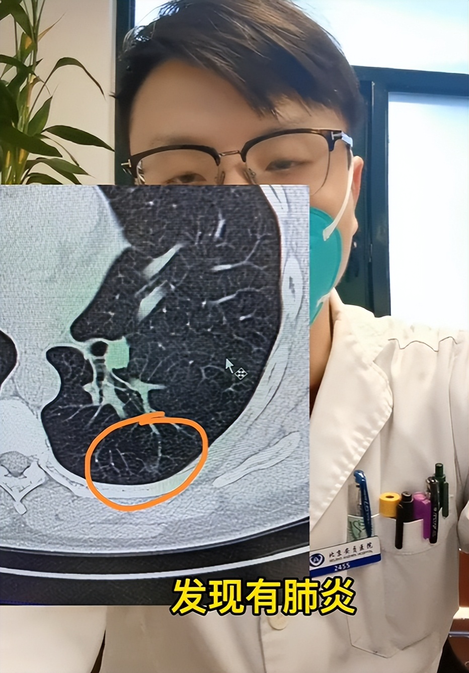 阳了之后有白痰是肺炎的征兆吗,新冠肺炎咳嗽痰中有血丝怎么治疗