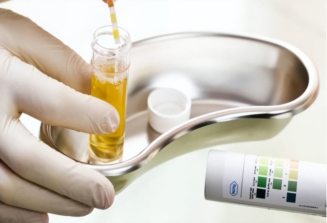 尿液柠檬黄是什么原因引起的,尿液黄泡沫多是什么原因