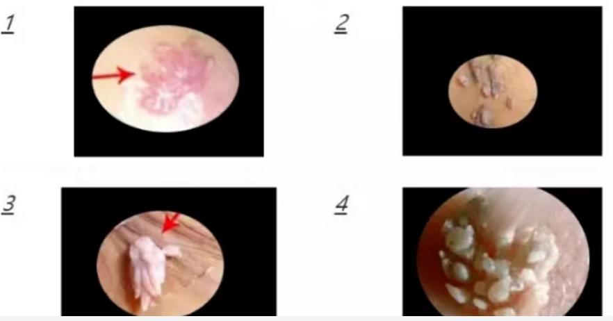 尖锐性湿疣复发前有什么特征,尖锐性湿疣复发多久会表现出来