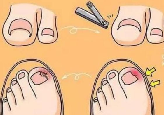 甲沟炎脚趾疼怎么缓解,足部甲沟炎怎么消肿