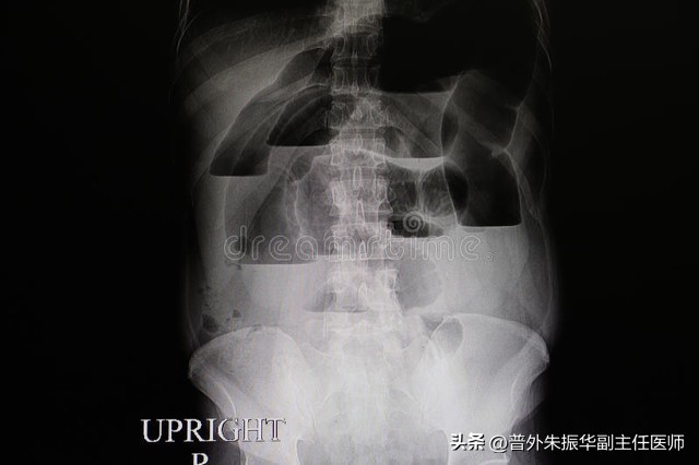 发生肠梗阻最好的治疗方法是,小孩肠梗阻怎么办