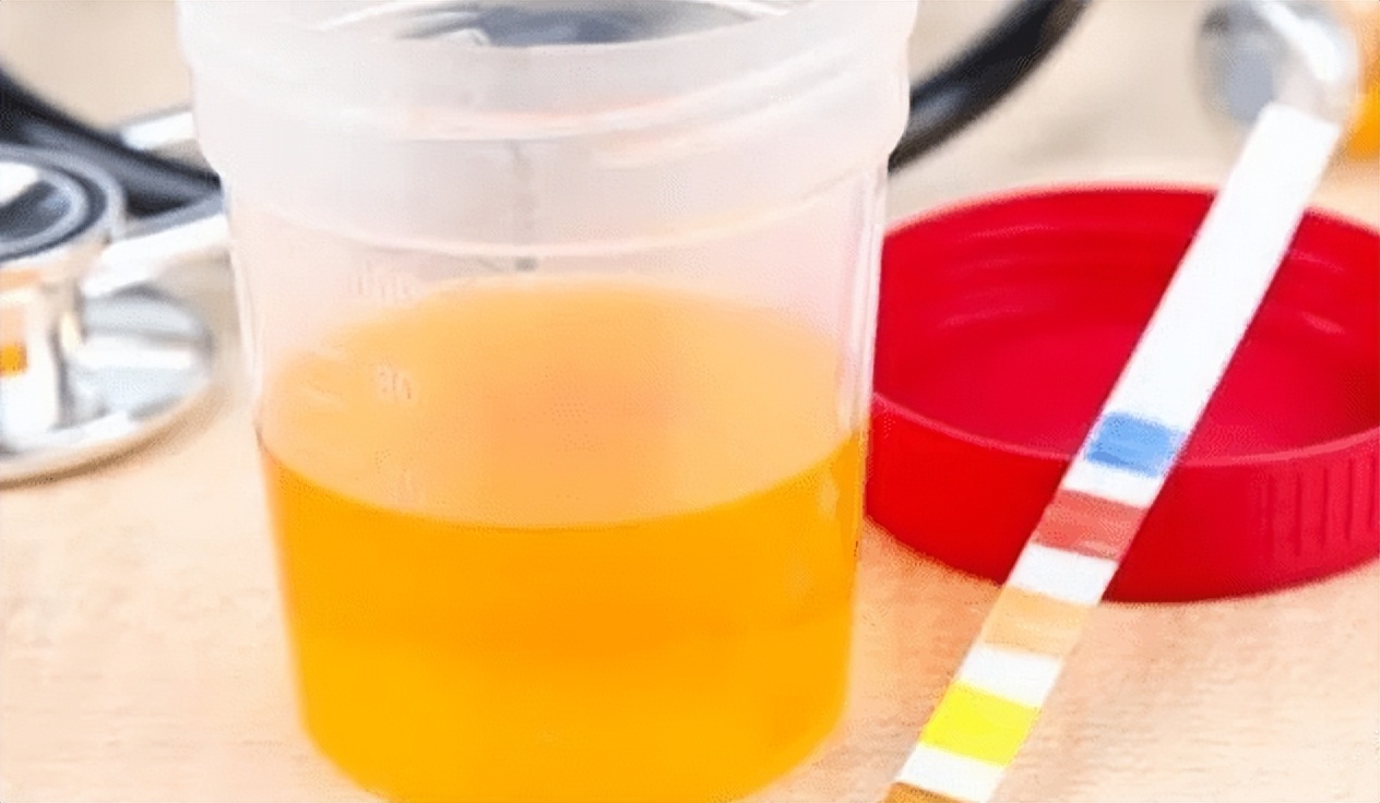 体检查出尿蛋白高是怎么回事,尿蛋白升高是一种什么病的前兆