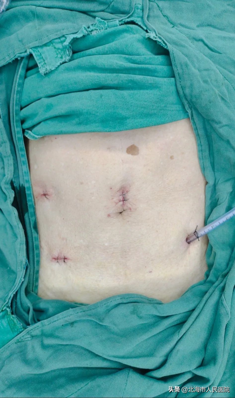 noses手术是大手术吗,noses手术操作视频