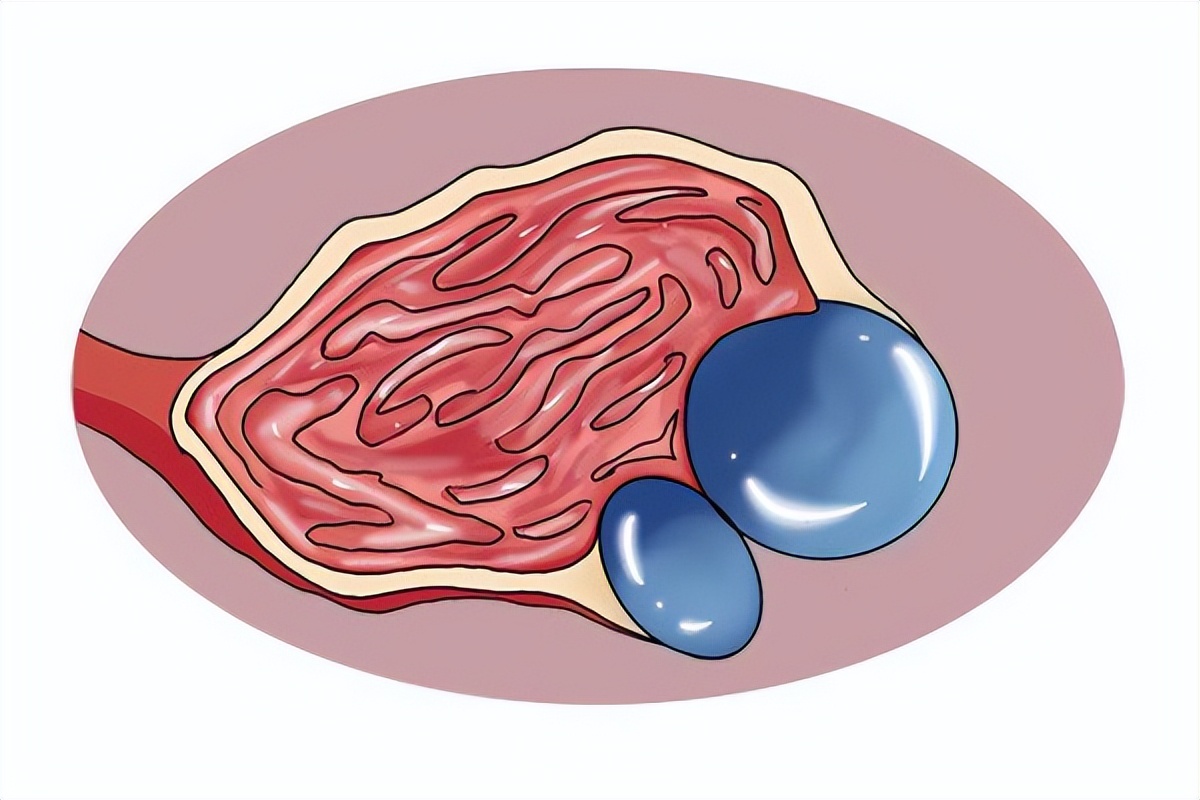 医生提醒大多数囊肿无需处理,请问囊肿有什么需要注意的吗