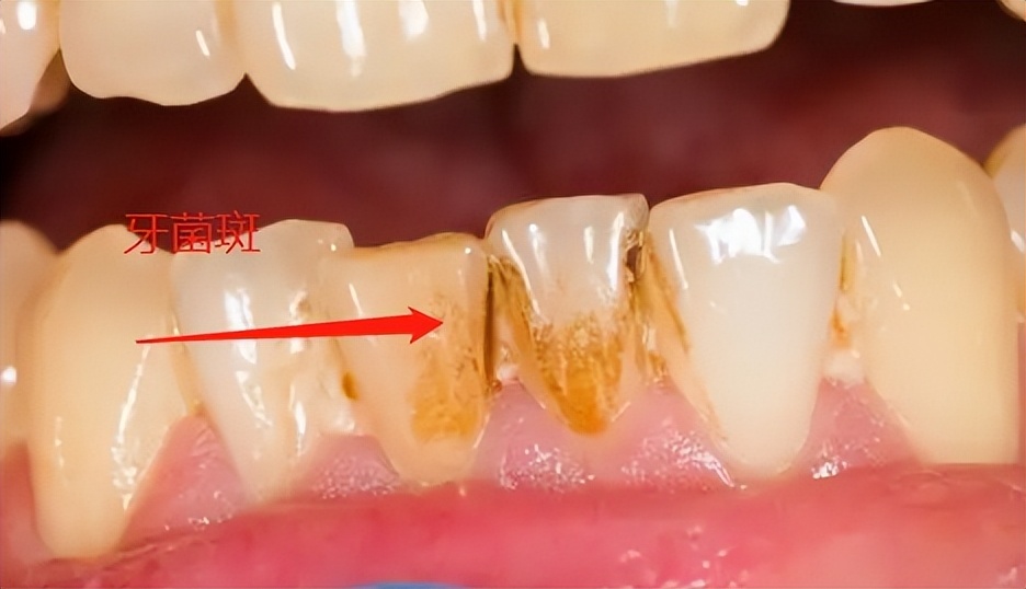 蛀牙有什么注意事项,蛀牙龋坏怎么预防