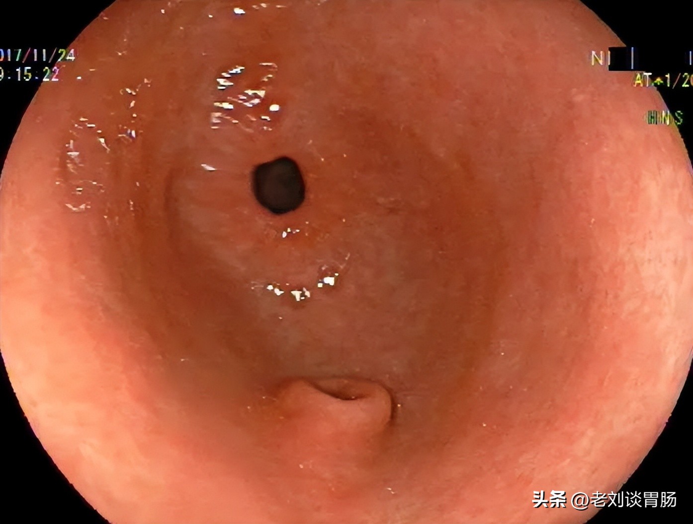 什么是异位灶怎么治疗,异位胰腺是怎么引起的