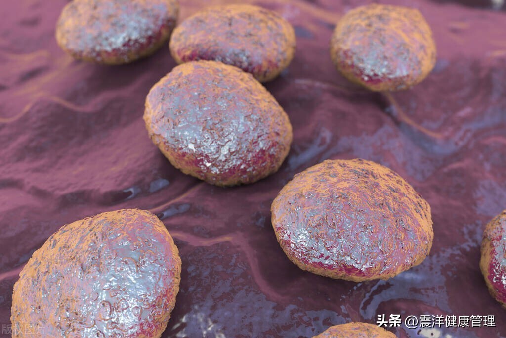 男子腹部痒，医生用镊子夹出16只阴虱！原来阴虱的传播途径有4个