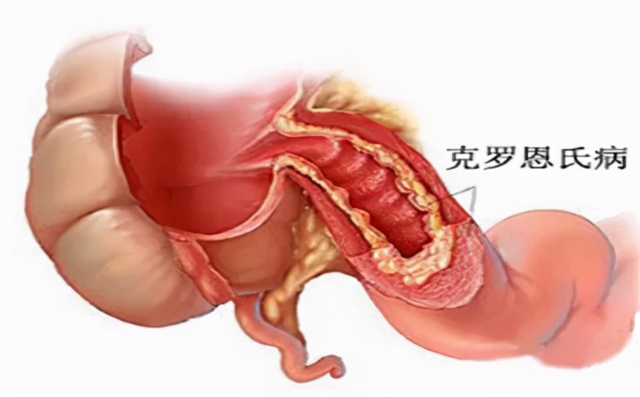 慢性肠炎大便不成形腹部隐痛,慢性肠炎经常大便不成形吃什么药