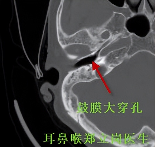 老人耳朵听力差怎么治疗,老年人耳朵流脓需要手术切除